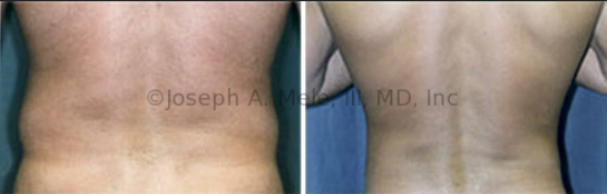 Male Muffin Top Removal - Liposuction of the Body