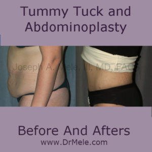 Abdominoplasty (Tumy Tuck) before and after pictures
