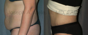 Tummy Tuck (Abdominoplasty) Before and After Pictures - side view