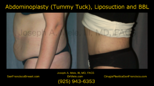 Tummy Tuck (Abdominoplasty) Videos with Before and After Pictures