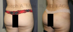 Brazilian Buttocks Lift before and after photos (BBL)