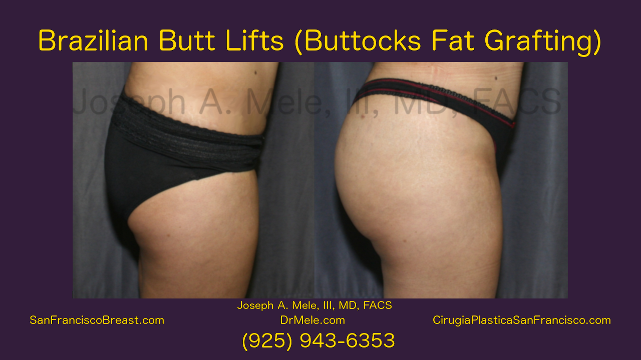 Brazilian Butt Lift Video (BBL) Buttocks Fat Grafting