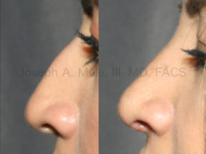 Rhinoplasty Before and After Pictures (Nose Job to Removal the Bump)