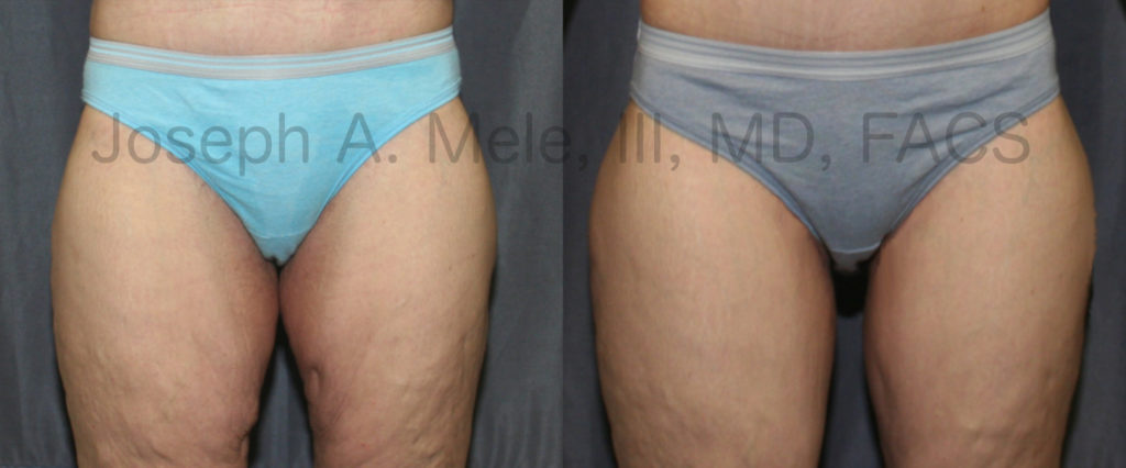 Thigh Lift Surgery Before and After Pictures
