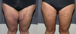 Thigh Lift Before and After Pictures with Vertical Medial Thigh Incision