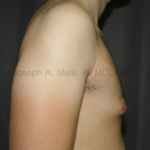 Gynecomastia reduction for tubular breasts in a man