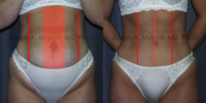 Abdominoplasty Muscle Tightening Before and After Pictures