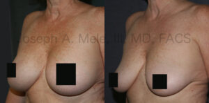 Breast Implant Removal Before and After Pictures