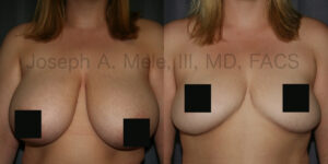 Breast Reduction Before and After Pictures - Front View