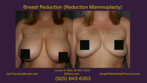 Great Reduction Before and After Pictures - Female Reduction Mammoplasty video presentation