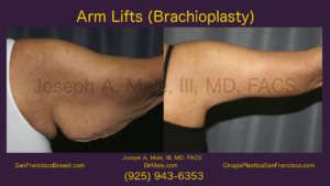 Arm Lift Video Presentation with Brachioplasty Before and After Pictures