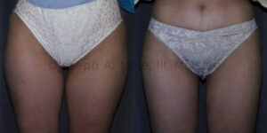 Liposuction of the Thighs before and after pictures (Female Saddlebags)