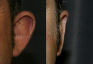 Otoplasty before and after pictures for prominent ears.