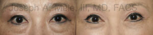 Asian blepharoplasty - double eyelids surgery before and after photos