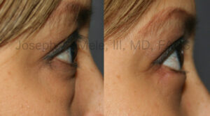 Lower blepharoplasty before and after photos - cosmetic lower eyelid lift