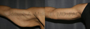 Brachioplasty - Arm lift surgery after weight loss before and after pictures