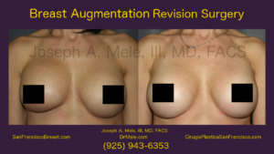 Breast Augmentation Revision Surgery Video Presentation with before and after pictures.