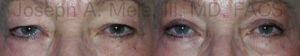 Asian Eyelid Lift (Blepharoplasty) for Tired Eyes before and after photos