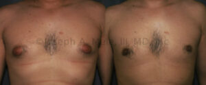 Gynecomastia Reduction Surgery before and after pictures - Liposuction and Gland Resection