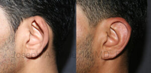 Otoplasty before and after pictures - cosmetic ear surgery for the correction of cupped (lop) ears (man)