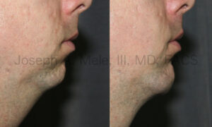 Male Chin Augmentation before and after pictures (Chin Implant)