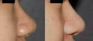 Dorsal Nasal Implant - Nasal Augmentation before and after pictures
