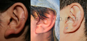 Earlobe Reduction before and after pictures with interoperative view.