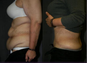 Heavy Weight Tummy Tuck - Abdominoplasty before and after pictures