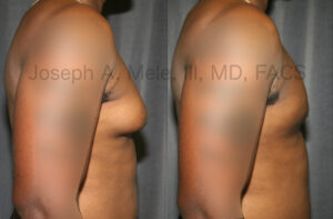 Male breast reduction before and after pictures.