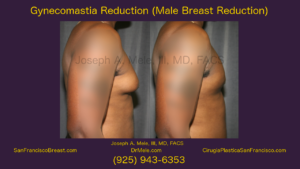 Male breast reduction for "man boobs" or gynecomastia