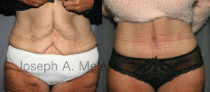 Tummy Tuck Video Presentation (Abdominoplasty) with before and after pictures