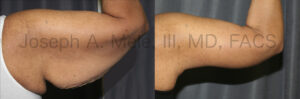 Arm Lift Before and After Pictures (Brachioplasty Photos)