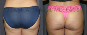 Brazilian Buttocks Lift (BBL) - Before and After Picture - Butt Lifts