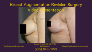 Breast Augmentation Revision Surgery - with Breast Implant revision before and after pictures