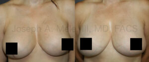 Breast Augmentation Lift Revision Surgery (censored version)