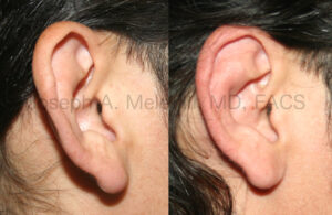 Otoplasty - correction of prominent ears by reducing and rotating the concha.