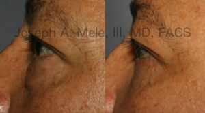 Lower Eyelid Lift before and after pictures (Blepharoplasty)