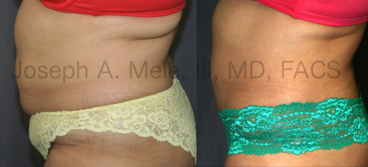 Maximizing Mini Tummy Tuck Before and After Results