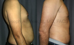 Mini Tummy Tuck Before and After Pictures (Mini Abdominoplasty)