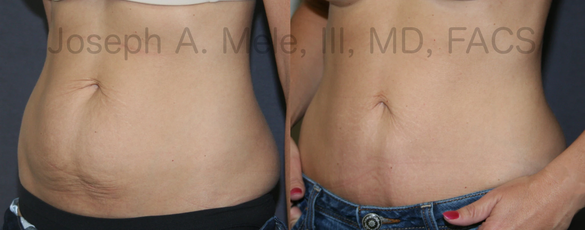 Best Tummy Tuck Before and After -100% Safe & Secure Surgery
