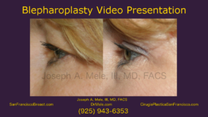 Blepharoplasty Video (Eyelid Lifts) with before and after pictures
