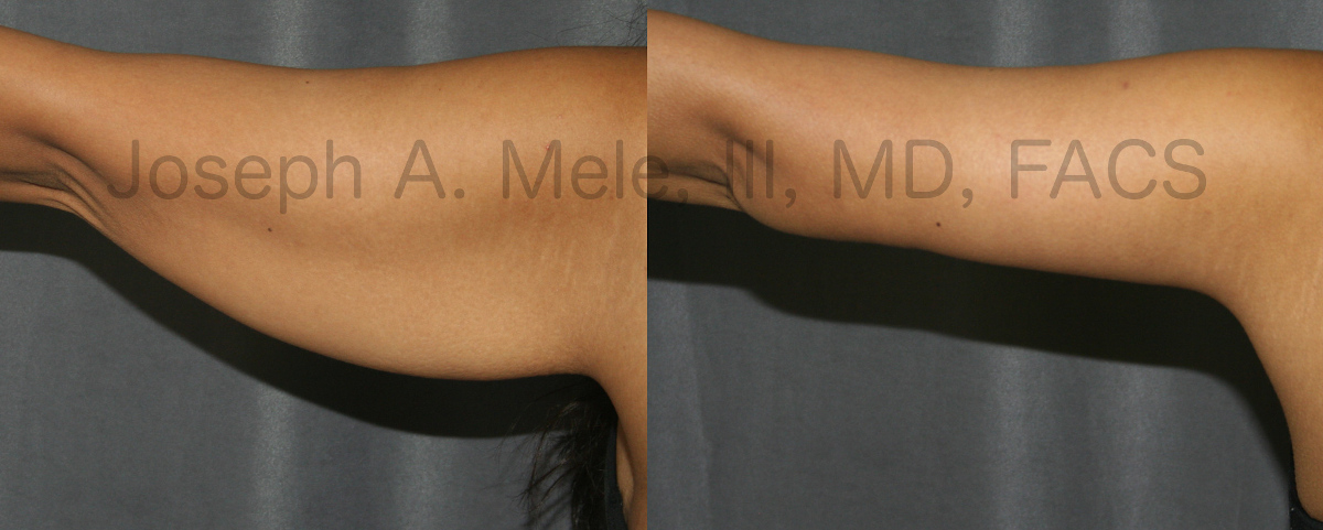 A before and after view of a successful brachioplasty procedure. An untoned  arm is seen on