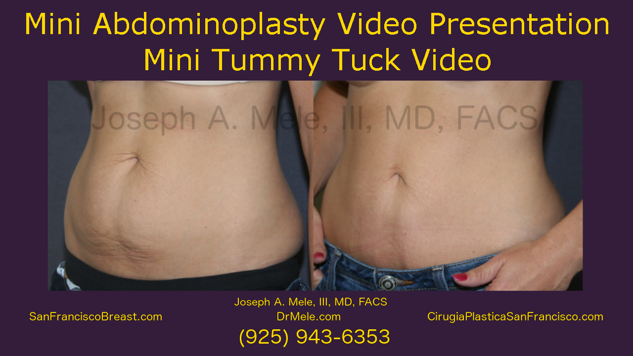 Mini Tummy Tuck Video (Mini Abdominoplasty)