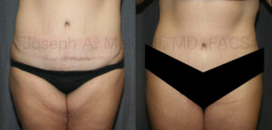 Thigh Lift after Weight Loss (Post-Bariatric Thighplasty) before and after photos