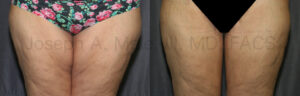 Thigh Lift after Weight Loss (Post-Bariatric Thighplasty) before and after photos