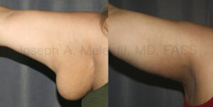 Arm Lift Before and After Pictures (Brachioplasty)