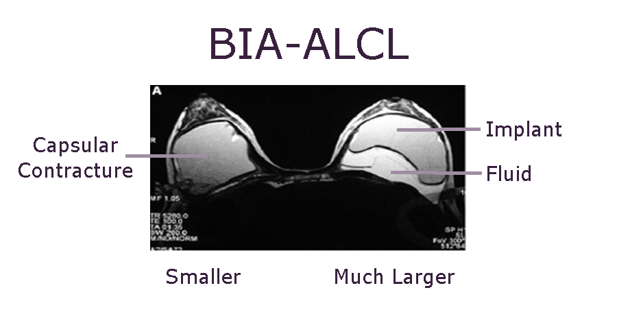 BIA-ALCL Update 2022