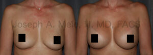 Gummy Bear Breast Implant Breast Augmentation Before and After Pictures (censored)