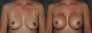 Gummy Bear Breast Implant Breast Augmentation Before and After Pictures (uncensored)