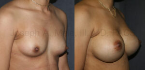 Gummy Bear Breast Implant Breast Augmentation Before and After Pictures (uncensored)